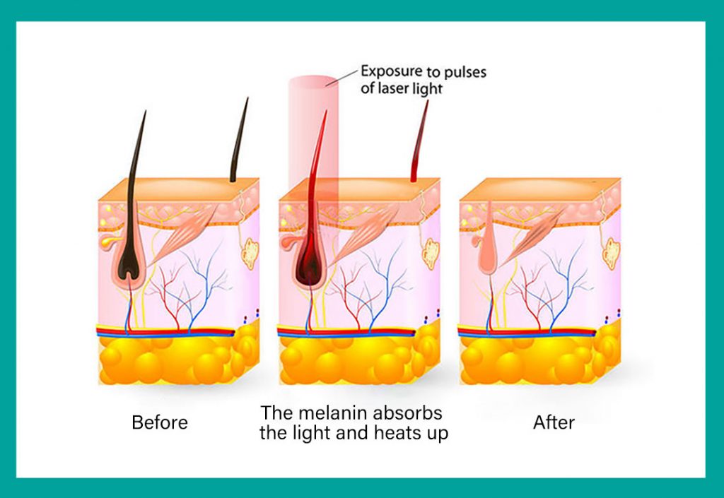 How to care after DPL precise skin rejuvenation